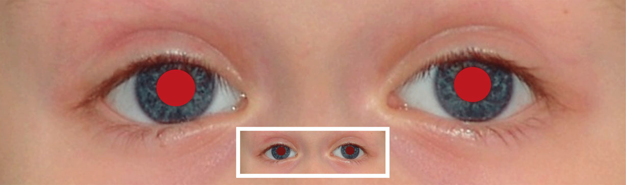 Beidseitige Myopie/Hyperopie