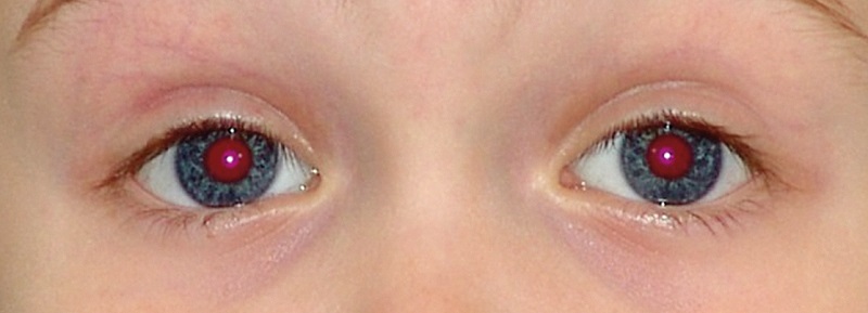 Fundusrotreflex