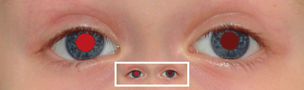 Diffuse Katarakt linkes Auge