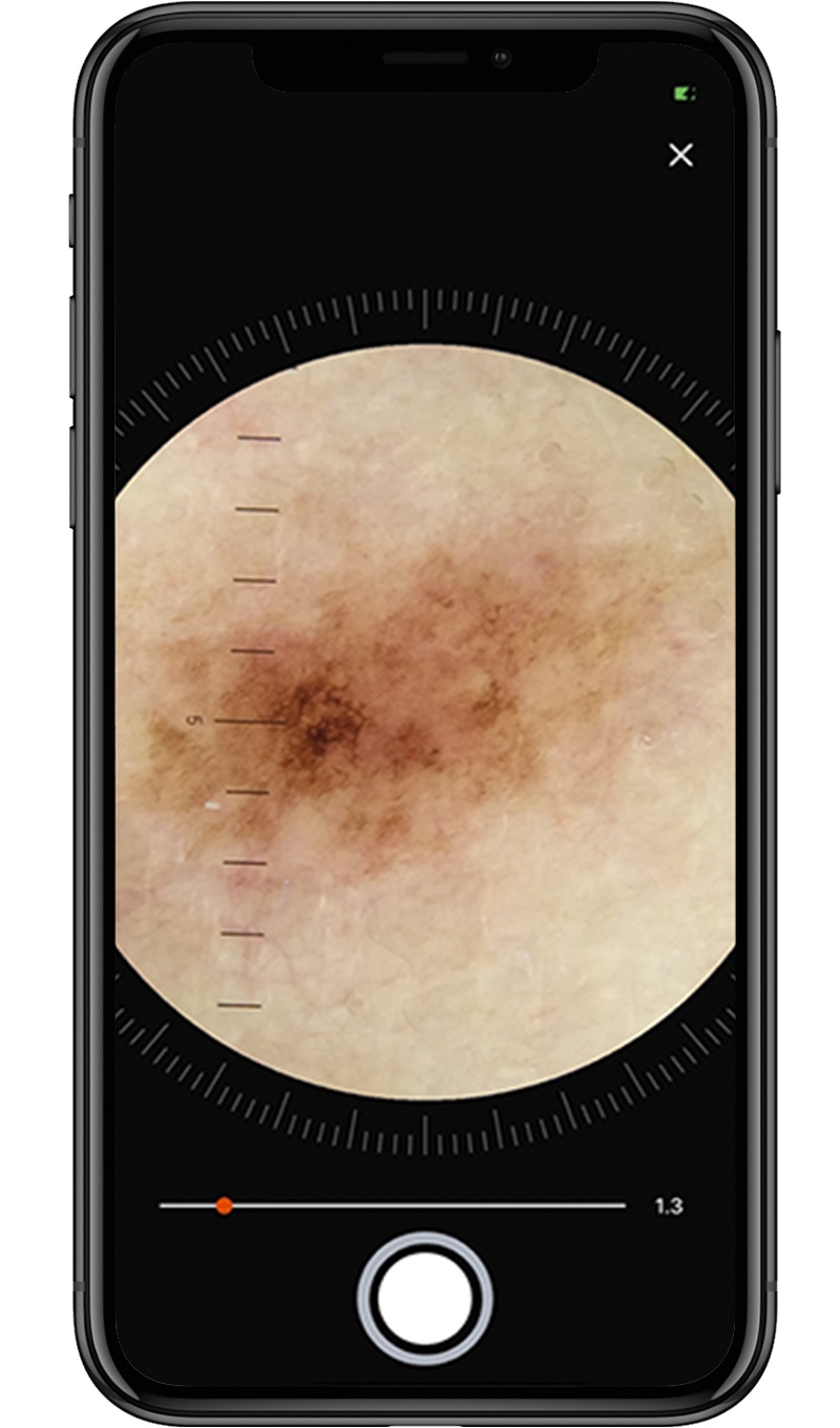 Workflow mit der HEINE DERM App Schritt-2