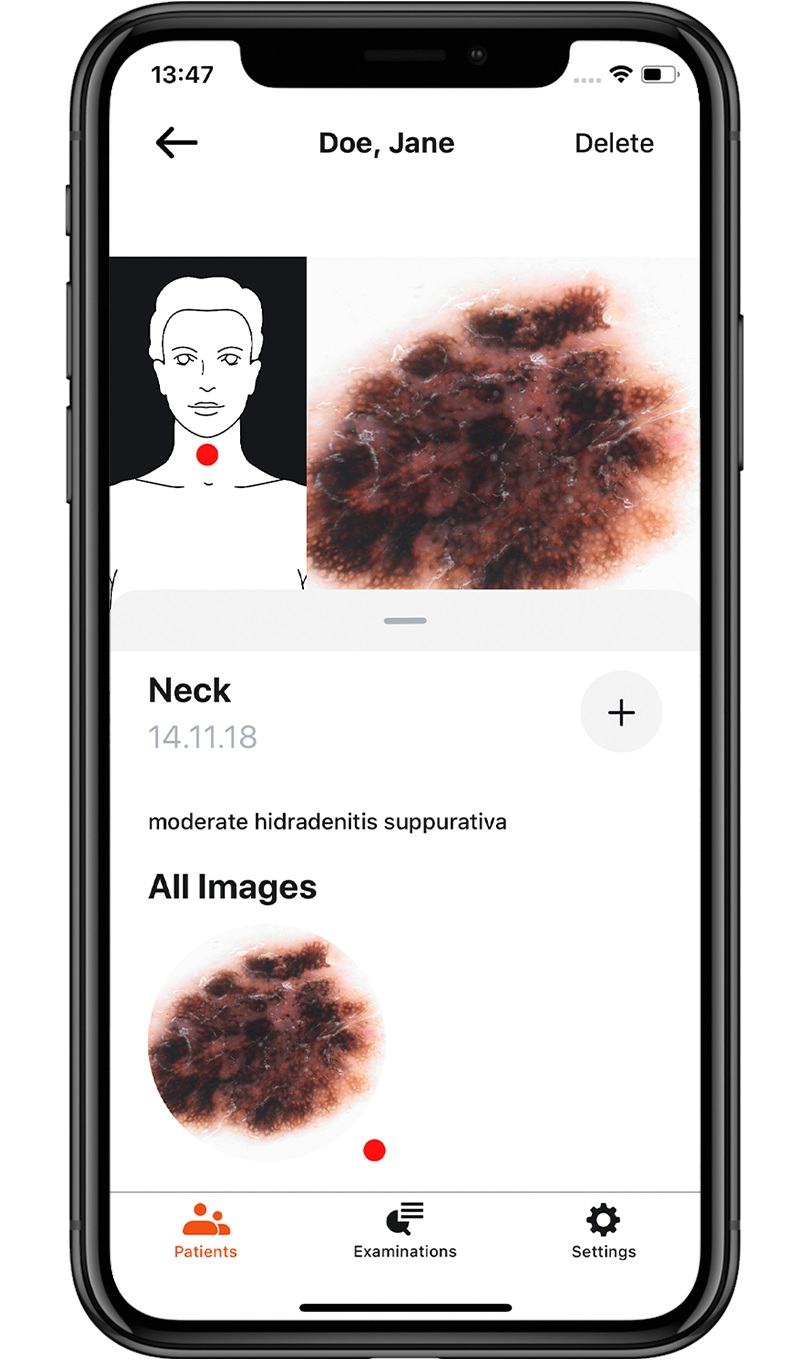 Dermatoskopie der makroskopisch auffälligen Nävuszellnävi