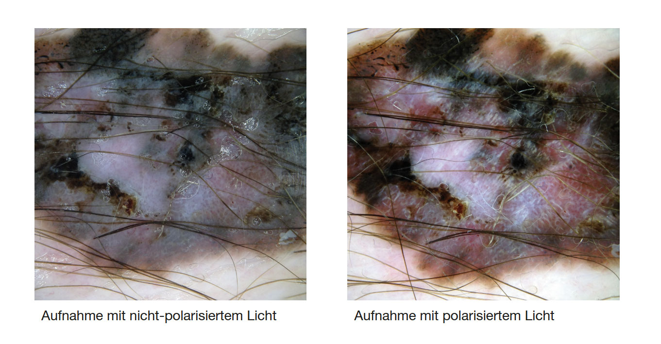 Wechsel von polarisiertem zu nicht-polarisiertem Licht-Melanom